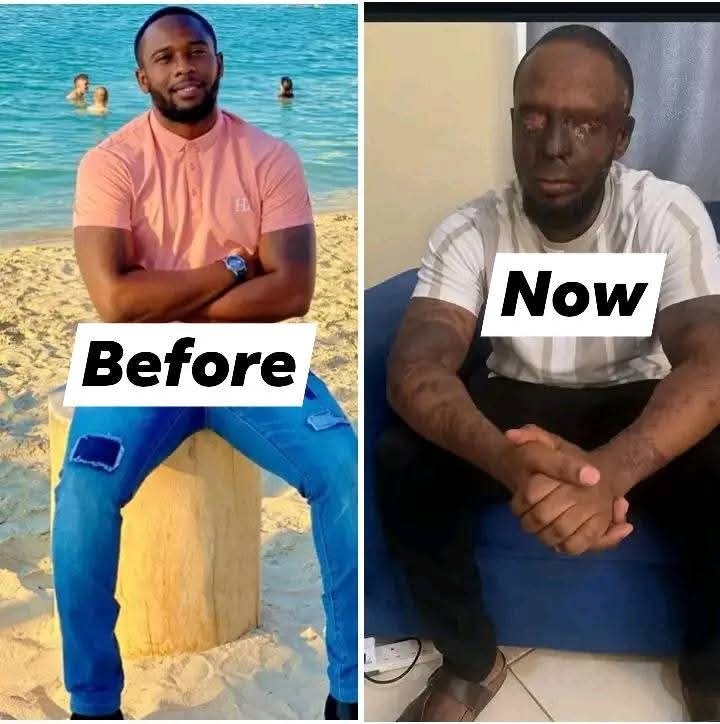 Sad: How a young guy, Tara Kipemba lost his two eye$$@*!$$s. 